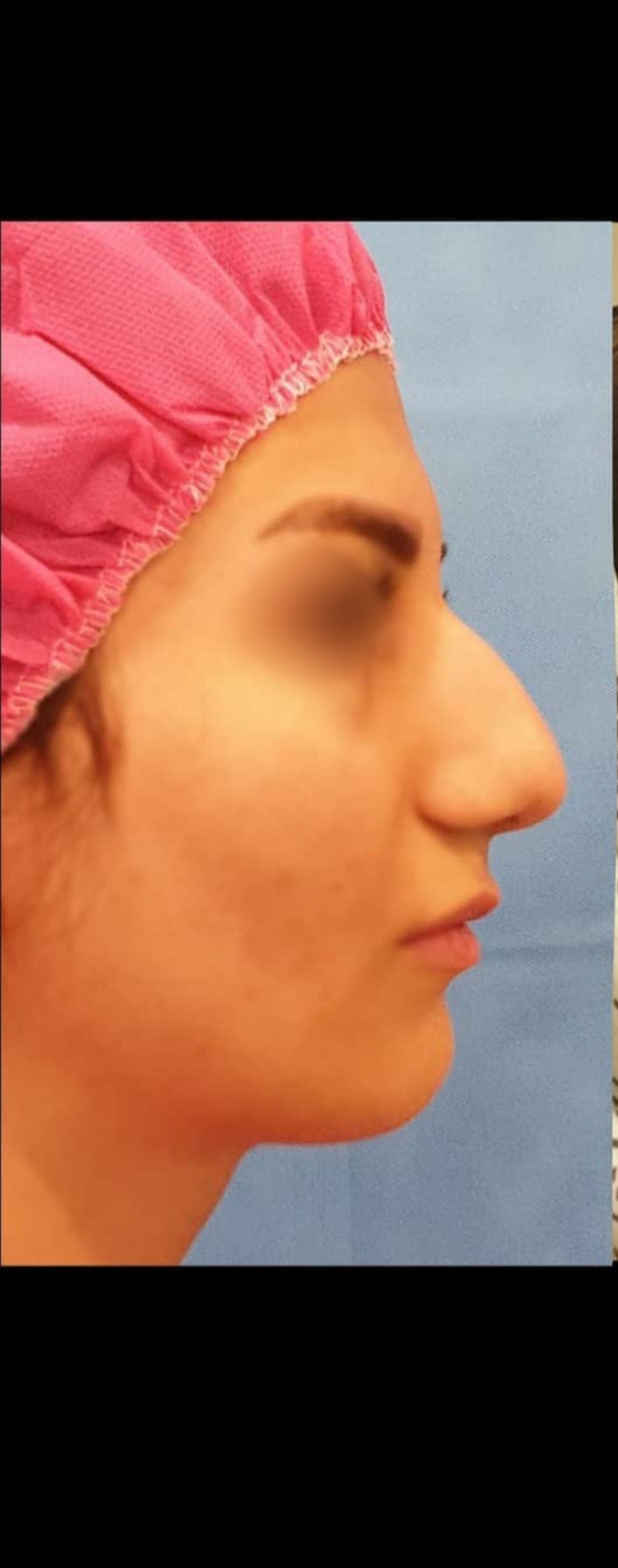 before-rhinoplasty-dr-amirreza-motabar