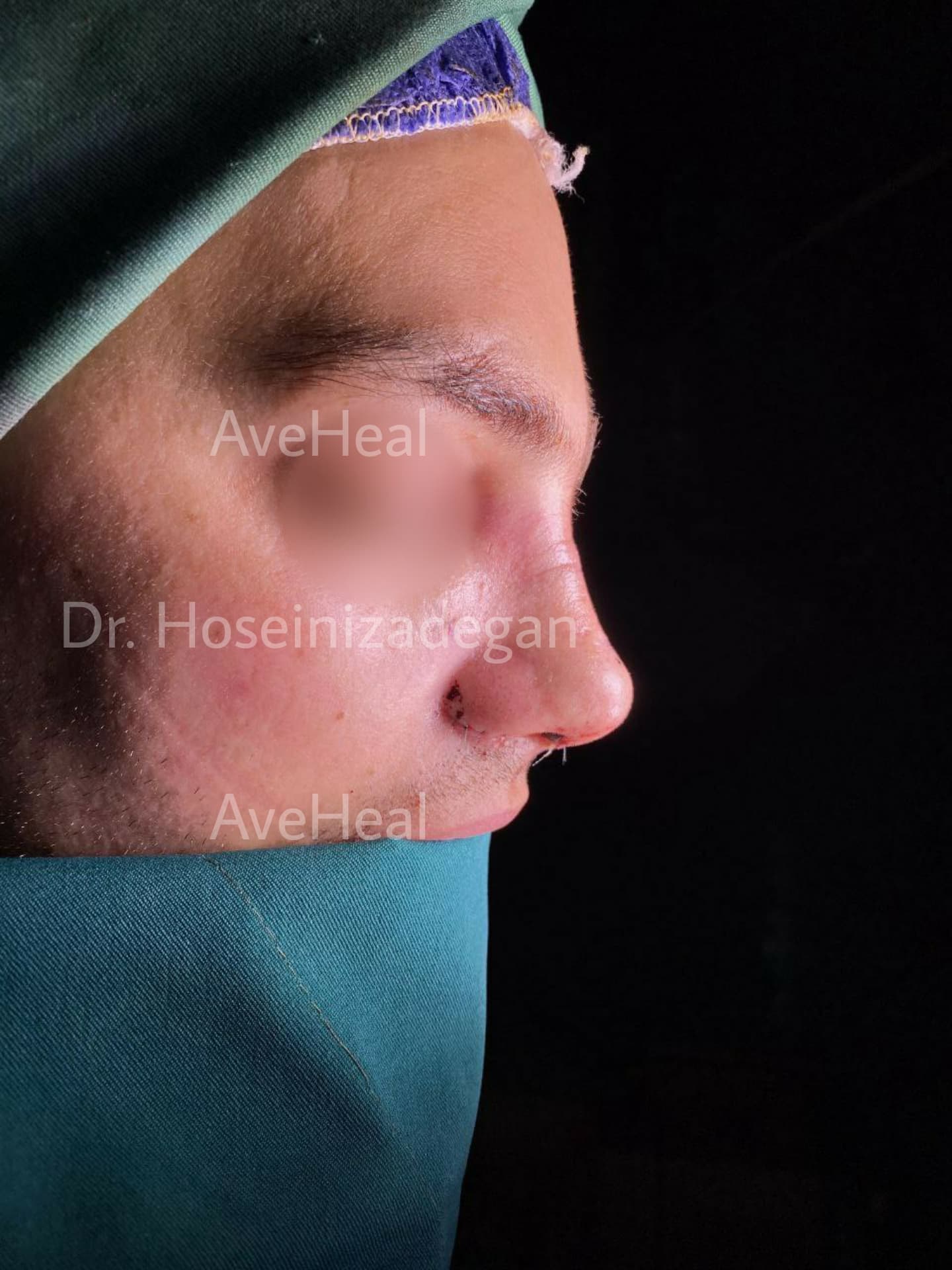 after-rhinoplasty-dr-fatemeh-hoseini-zadegan-shirazi