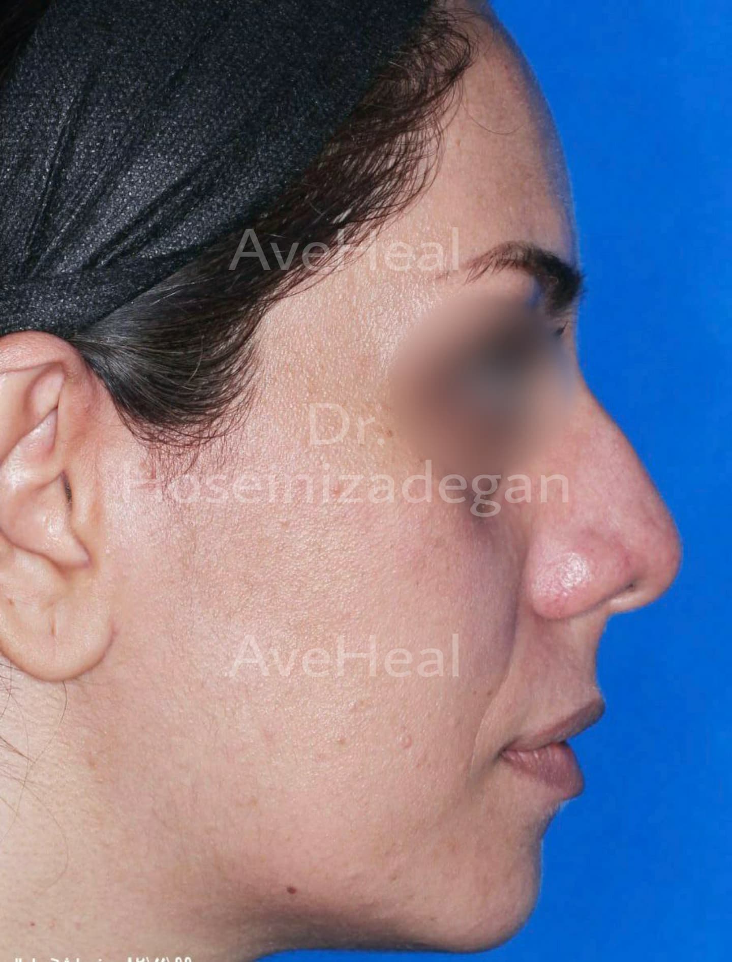 before-rhinoplasty-dr-fatemeh-hoseini-zadegan-shirazi