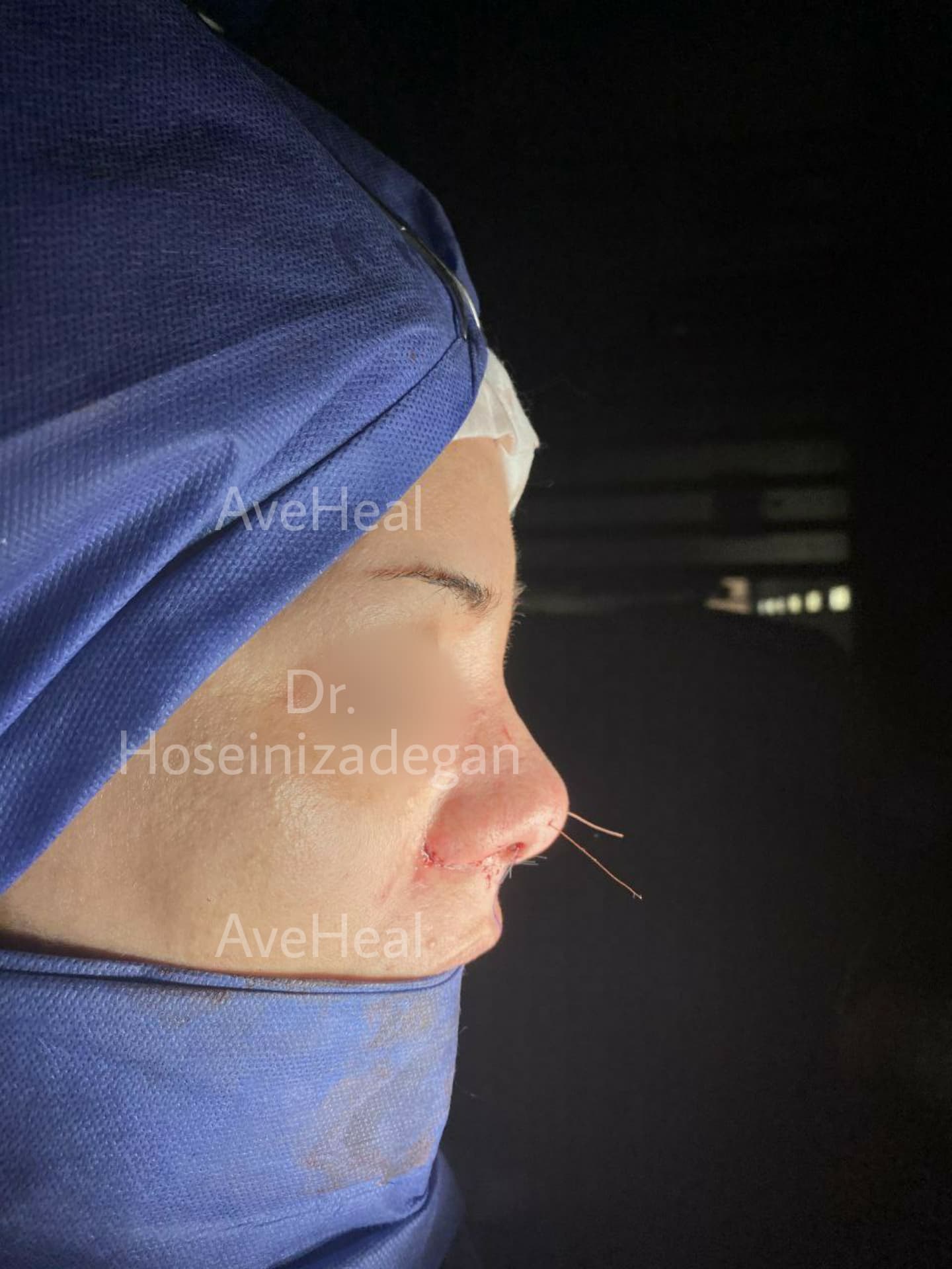 after-rhinoplasty-dr-fatemeh-hoseini-zadegan-shirazi