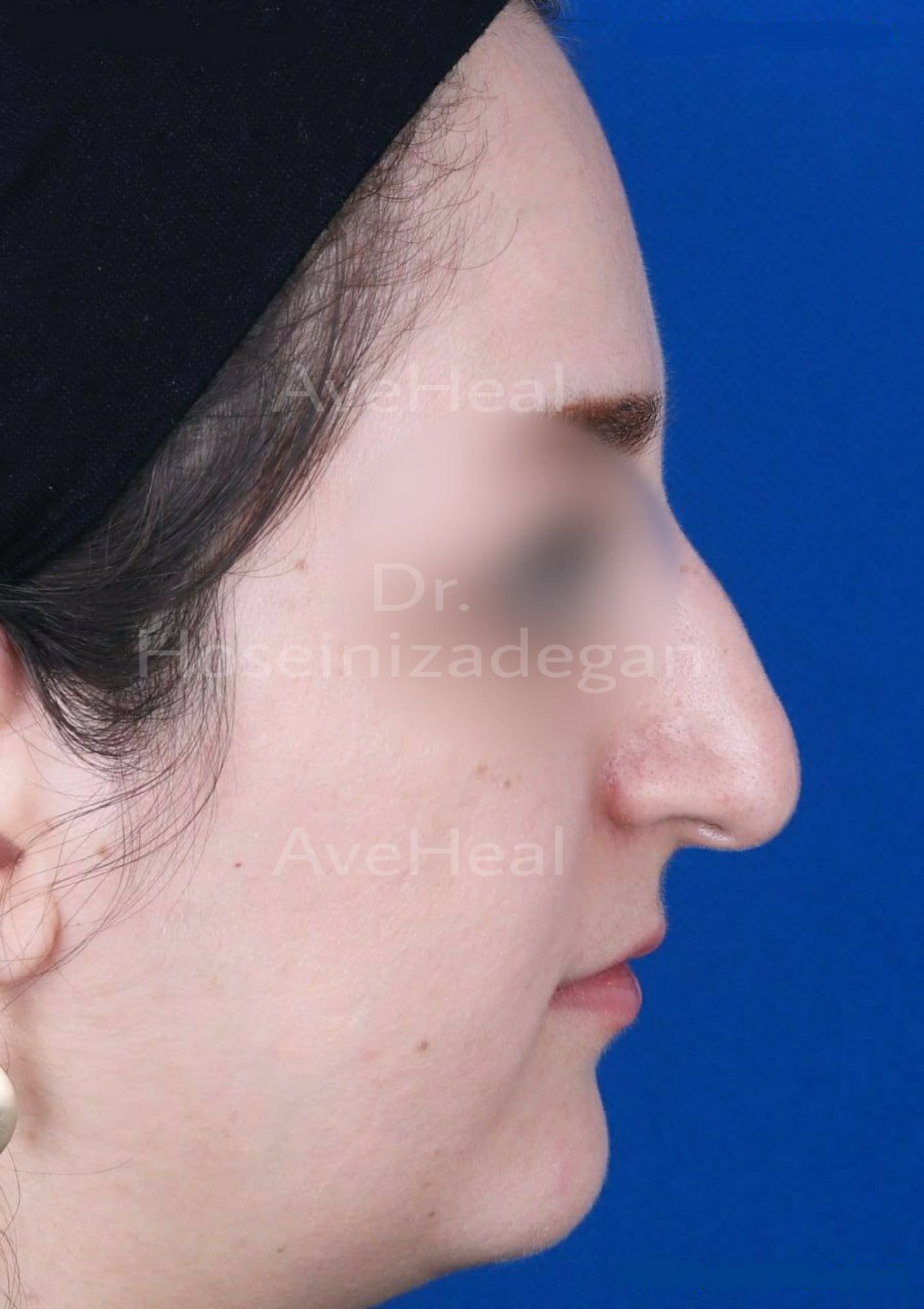 before-rhinoplasty-dr-fatemeh-hoseini-zadegan-shirazi